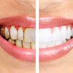 tooth erosion