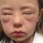 peanut allergy symptoms