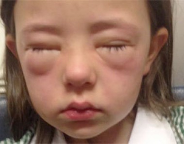 peanut allergy symptoms