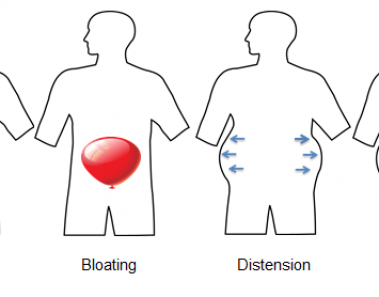 bloating and distention
