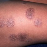 eczema