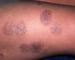 eczema