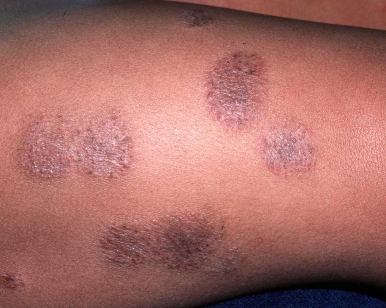 ringworm african american